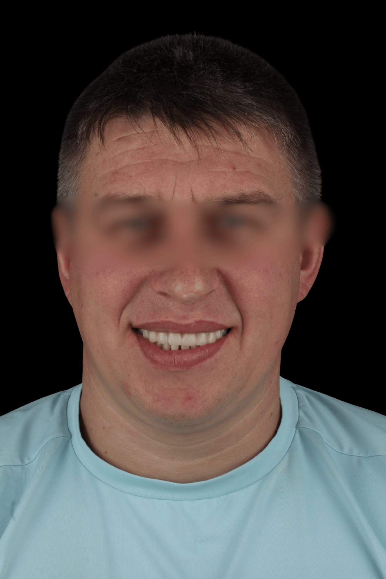 Максим — імплантація